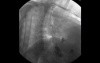 Adenocarcinoma of the Gastroesophageal Junction - Fluoroscopy