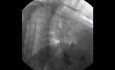 Adenocarcinoma of the Gastroesophageal Junction - Fluoroscopy