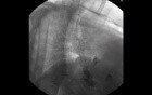 Adenocarcinoma of the Gastroesophageal Junction - Fluoroscopy
