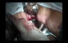 Removal of the Uterus Through the Vagina by Use Of Bipolar Vessel Sealer