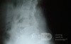 Spondylolesthesis L4-5