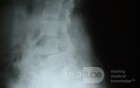 Spondylolesthesis L4-5