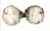 Largest Paratesticular Tumour Ever Reported In The World