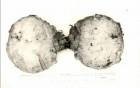 Largest Paratesticular Tumour Ever Reported In The World