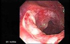 Multiple Adenomatous Polyps Of The Rectum (31 of 37)