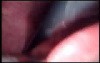 Colonic Perforation With Peritonitis - Laparoscopy (42 of 46)