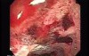 Lymphoma B small cells of the Jejuno (6 of 10)