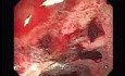 Lymphoma B small cells of the Jejuno (6 of 10)