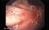 Adenocarcinoma of the Lesser Curvature with Signet Ring Cells (1 of 3) 2
