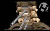 Anterior Cervical Corpectomy and Spinal Instrumentation