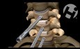 Anterior Cervical Corpectomy and Spinal Instrumentation