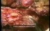 Right colon resection - Laparoscopy