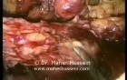 Right colon resection - Laparoscopy