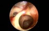 Functional Endoscopic Sinus Surgery (FESS)- 10Th Day post operative