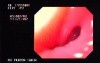 Esophageal Achalasia - Image of Narrowed Cardias