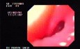 Esophageal Achalasia - Image of Narrowed Cardias