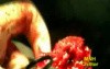 Cavernous Hemangioma In The Armpit