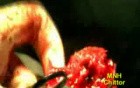 Cavernous Hemangioma In The Armpit
