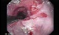 Endoscopic Baloon Dilation Of The Esophageal Stricture - Inflating The Baloon - Close-Up
