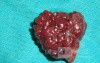 Giant Multilobulated Gastric Polyp (19 of 20)