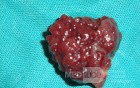 Giant Multilobulated Gastric Polyp (19 of 20)