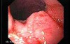 Adenocarcinoma of the Gastroesophageal Junction - Neoplastic Nodule