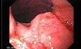 Adenocarcinoma of the Gastroesophageal Junction - Neoplastic Nodule