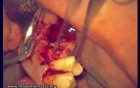 Immediate Implantation 14-18 (1/2)