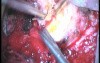 C1-C2 Schwannoma - Right Extradural Approach