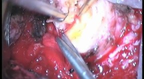 C1-C2 Schwannoma - Right Extradural Approach