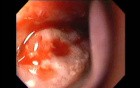 Massive Epistaxis - 76-year-old female patient - 7/8