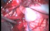 Medulloblastoma - Median Suboccipital Approach