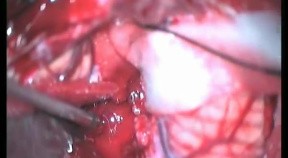 Medulloblastoma - Median Suboccipital Approach