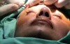 Eyebrow lift without incisions