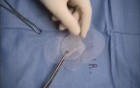 Inguinal hernia repair