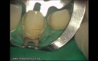 Ceramic Veneers Adhesive Cementation (1/4)
