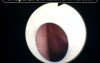The View of True Vocal Folds Vibrations Through T Tube