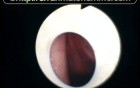 The View of True Vocal Folds Vibrations Through T Tube