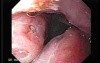 Enlarged tonsils - endoscopic view 1/2