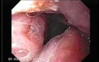 Enlarged tonsils - endoscopic view 1/2