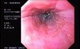 Banding of esophageal varices (9 of 17)