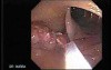Stalked Polyp - Polypectomy (4 of 6)