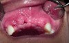 Bone Grafting #7-8-X-10 Sites - 2 Week p-o