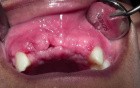 Bone Grafting #7-8-X-10 Sites - 2 Week p-o
