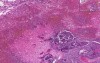 Lung - Acute Infarct - Septic