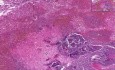 Lung - Acute Infarct - Septic