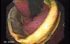 Penetration of Adjustable Laparoscopic Gastric Banding (1 of 4)