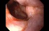 Massive Epistaxis - Final Alcohol Ablation Status - 6/8