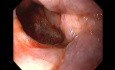 Massive Epistaxis - Final Alcohol Ablation Status - 6/8