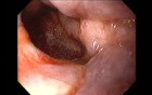 Massive Epistaxis - Final Alcohol Ablation Status - 6/8
